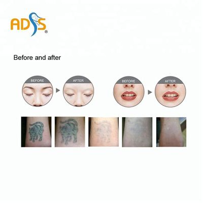 OEM / ODM Q Switch Yag Laser Tattoo Removal Machine ضمان سنتان